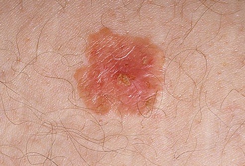 Skin Cancer Mesothelioma